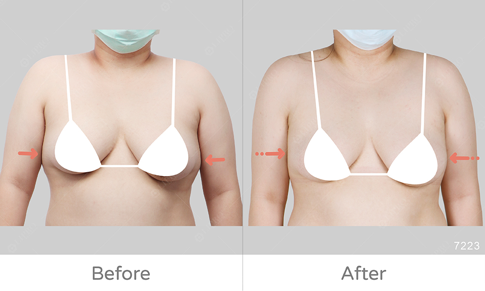 副乳太大影響手臂自然動作，麗波精緻抽脂消除副乳困擾