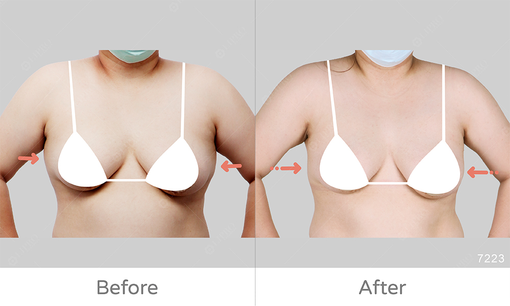 副乳太大手臂放不下，顯微套管抽脂處理腋下副乳問題