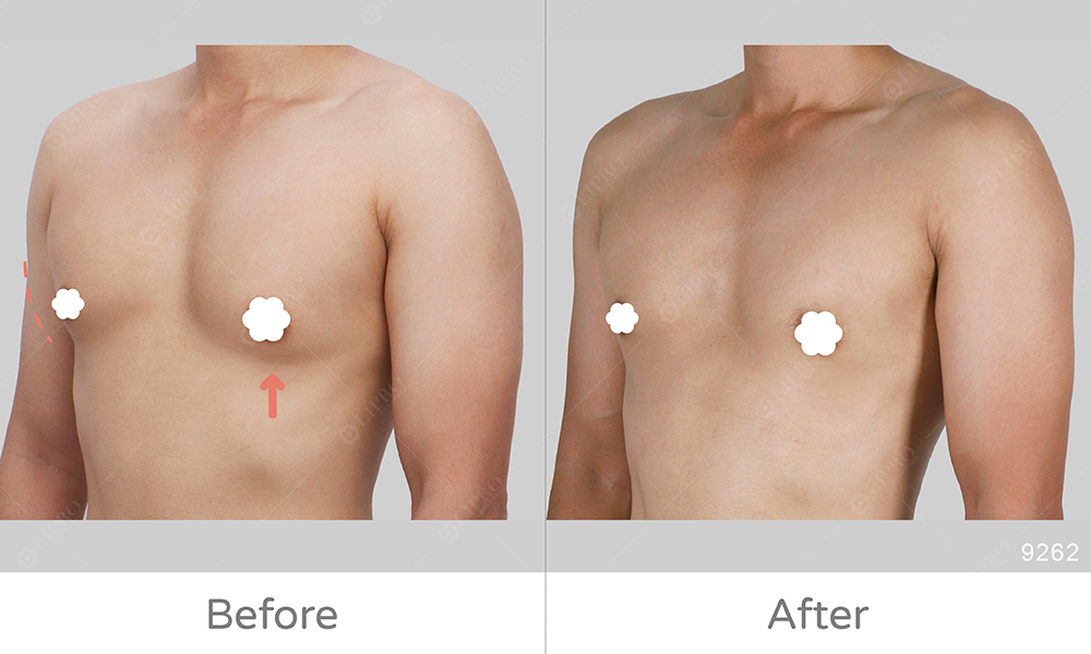 麗波永康男性女乳術前術後案例見證，傷口隱痕術後好照顧