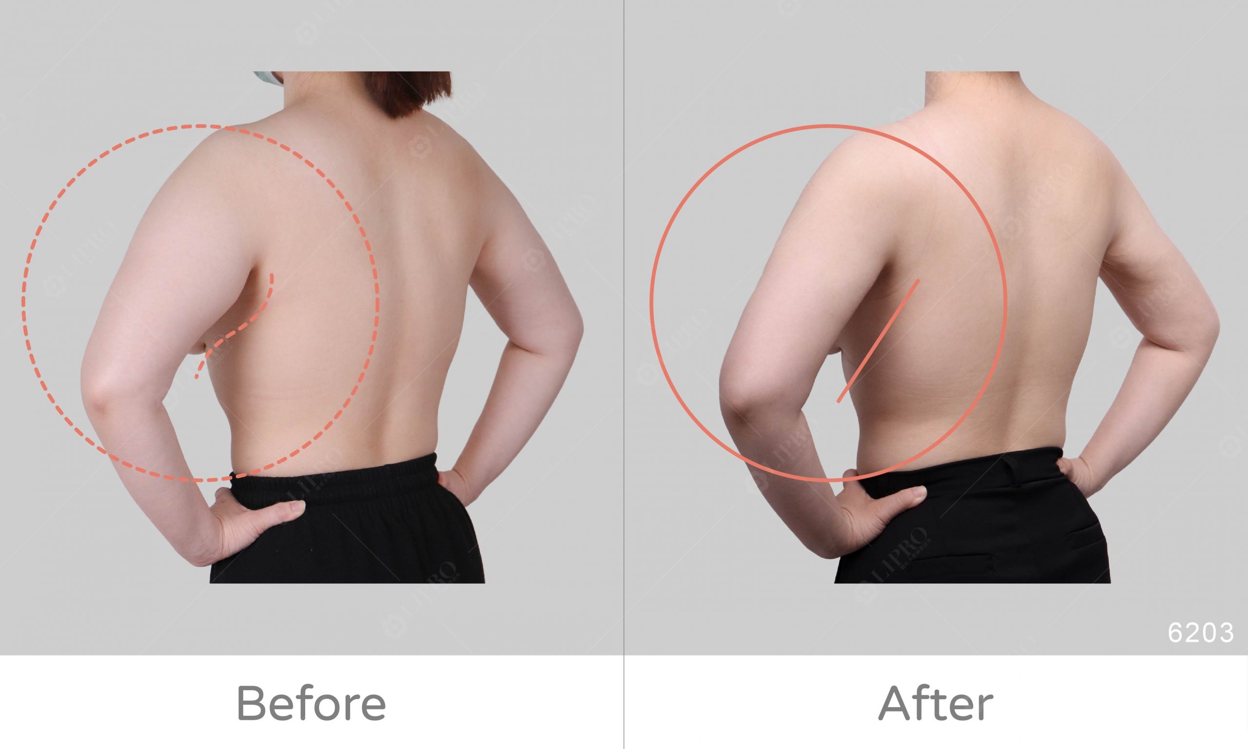 消除多年的副乳問題，好評分享麗波抽脂手術的體驗