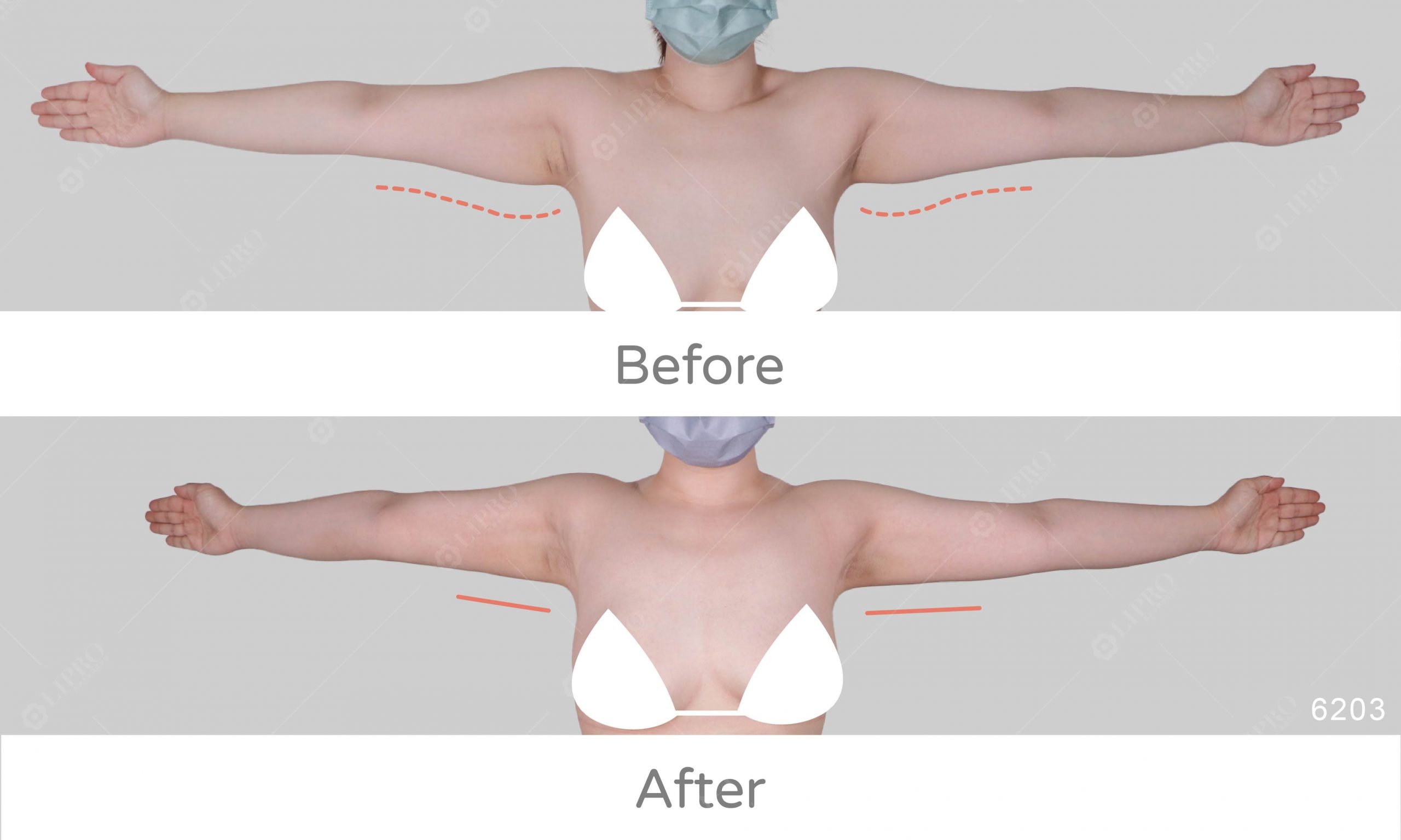 上半身曲線變得更好看，顯微套管抽脂最重要的是曲線的精緻美感