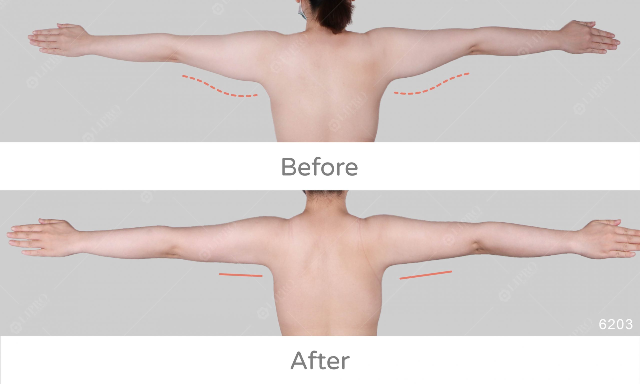 消除手臂贅肉，顯微套管手臂抽脂的心得分享