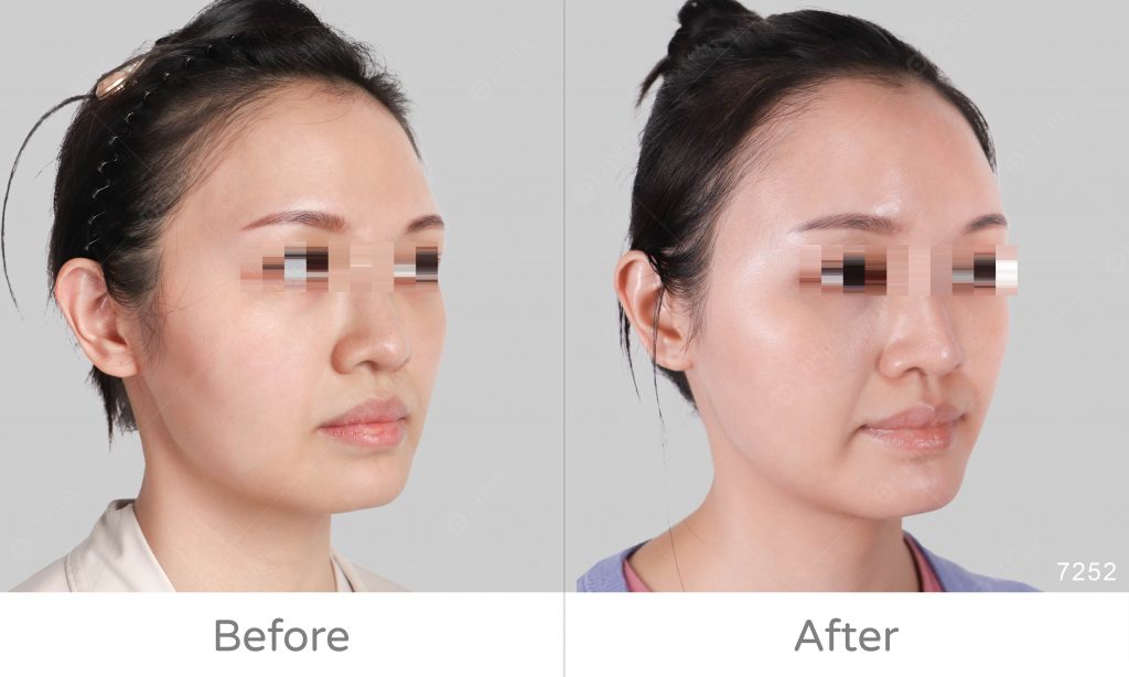 臉部補脂案例，麗波永康自體脂肪補臉術後成效圖