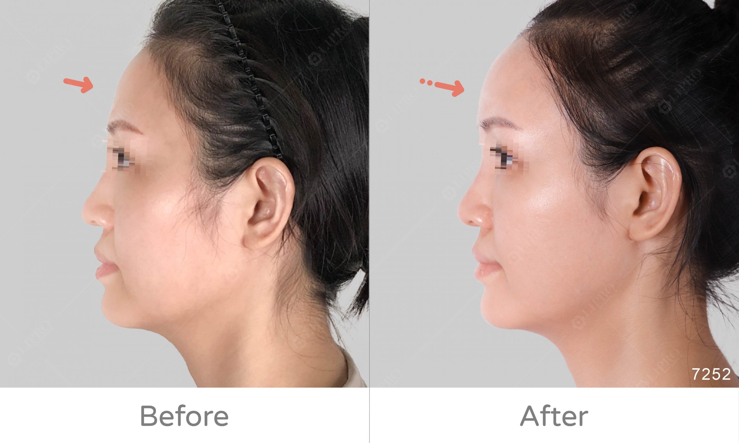 臉部自體脂肪移植，重新找回臉部澎潤感，麗波補臉案例見證