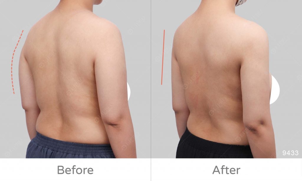 虎背熊腰案例、修飾後背曲線，抽脂最重要的是曲線的展示