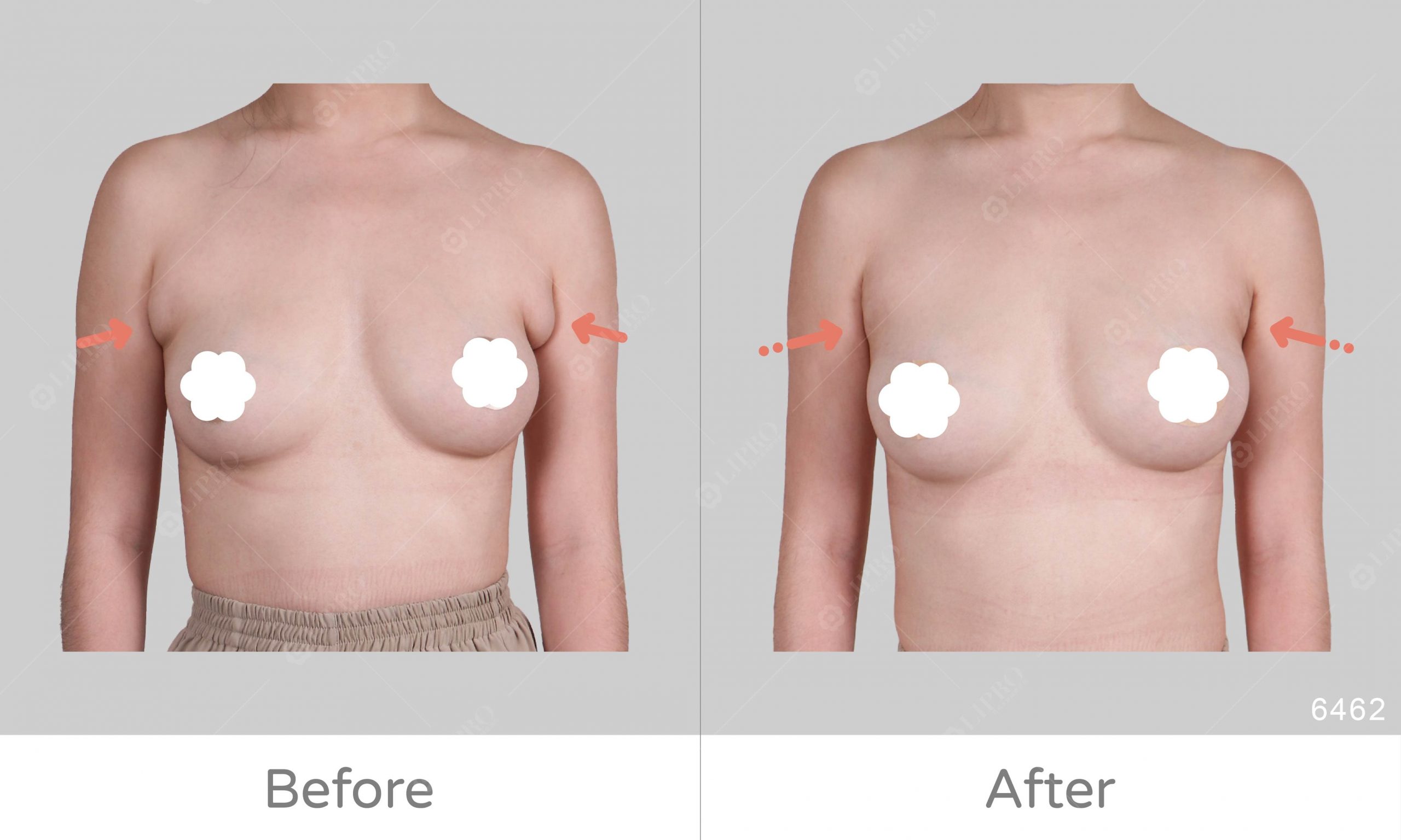 一日抽脂、副乳移除，不須切皮不用住院，一天就擺脫多年的副乳困擾
