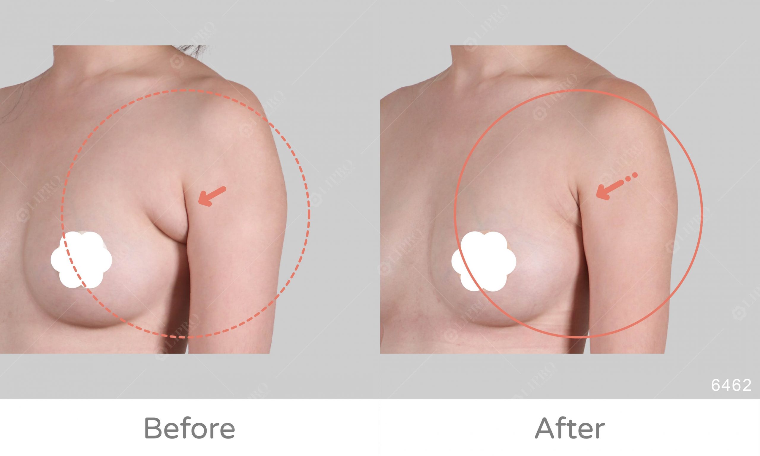 一次手術就解決副乳困擾，副乳案例對比你看得見