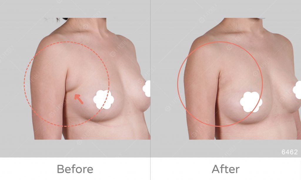 副乳抽脂案例術後效果如圖所示，豐富案例經驗、副乳困擾讓麗波幫你解決