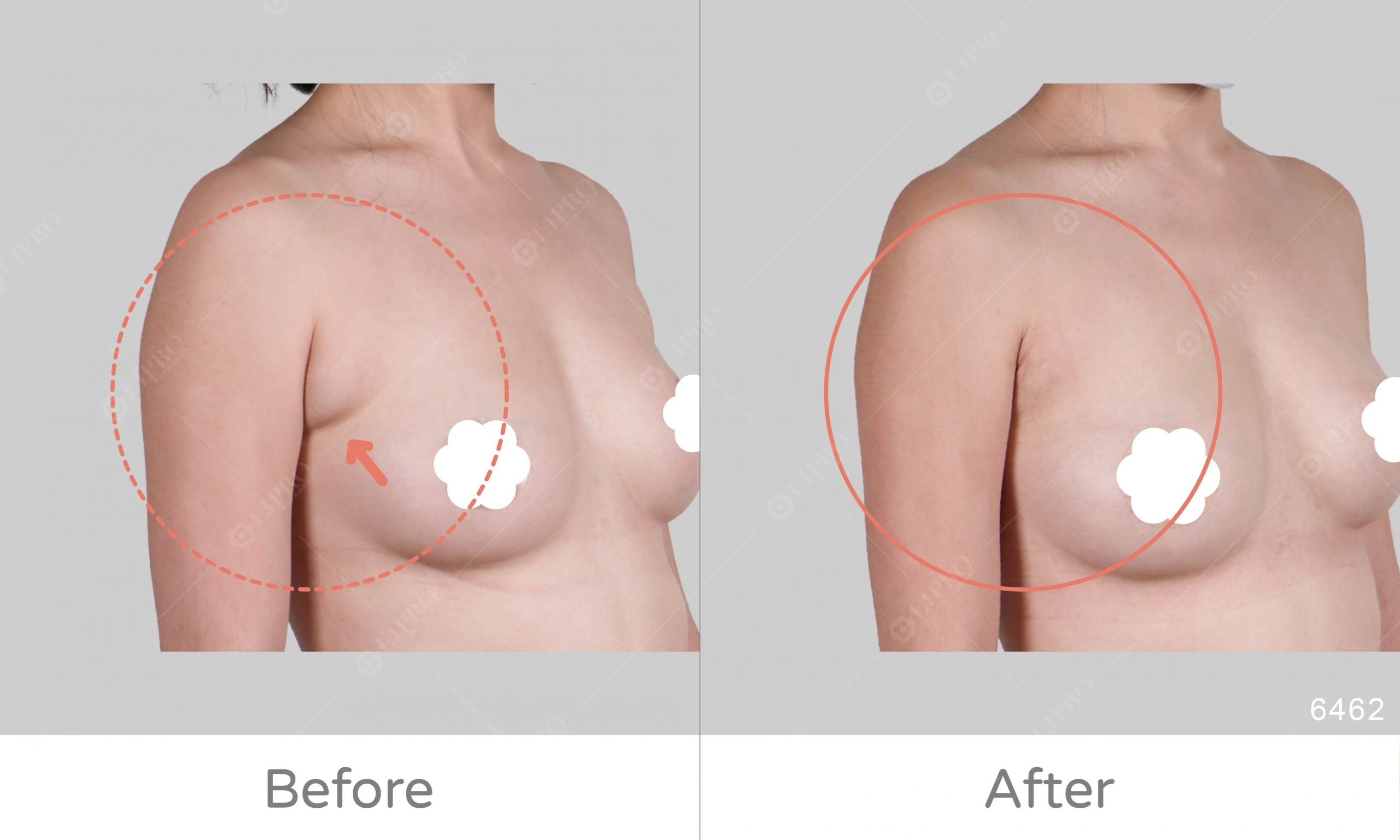 副乳抽脂案例術後效果如圖所示，豐富案例經驗、副乳困擾讓麗波幫你解決