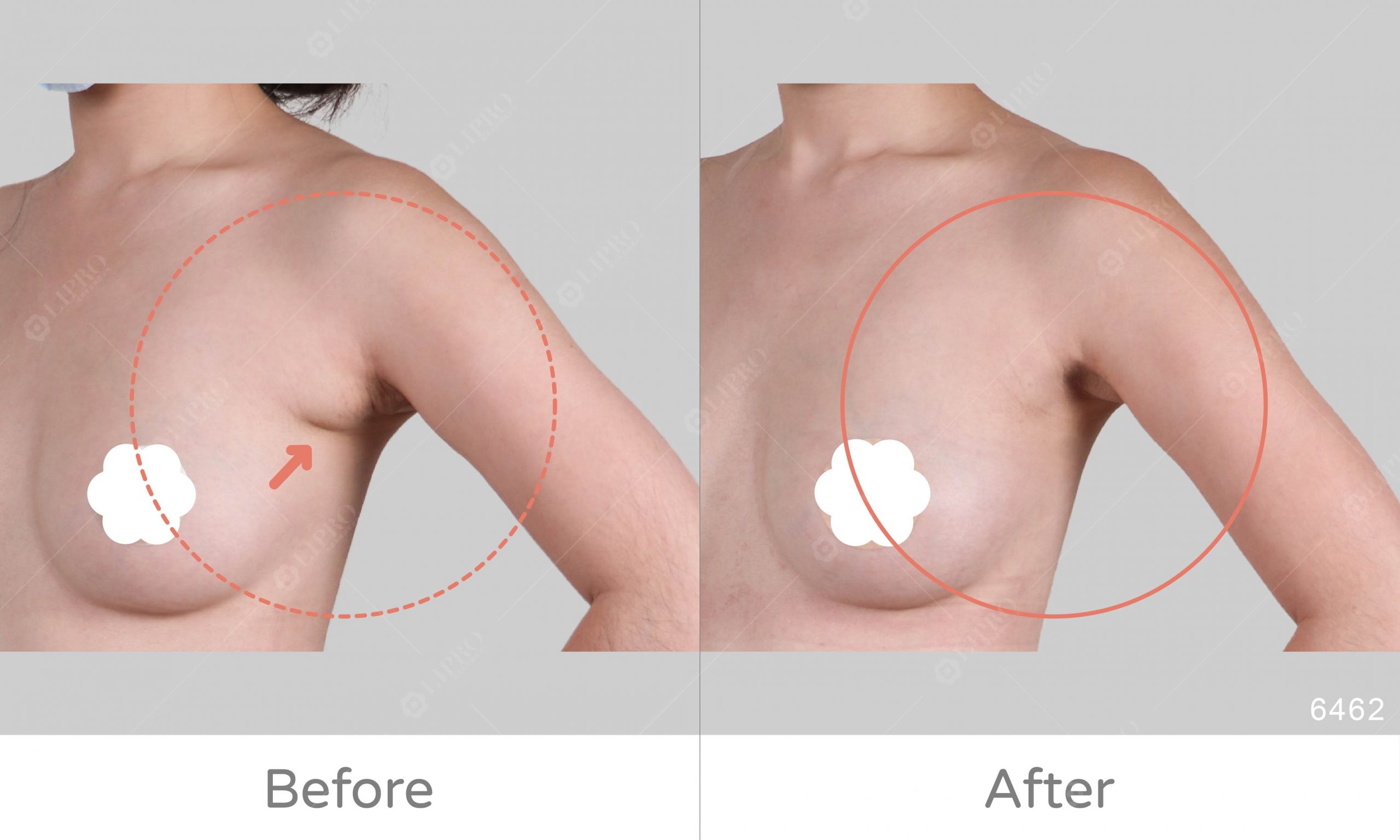 可選擇清醒手術的抽脂方式更令人安心，副乳抽脂術後成效看得見