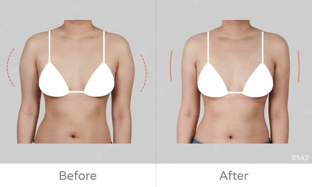 手臂抽脂術前術後成果比對，不須穿塑身衣的抽脂、傷口極小