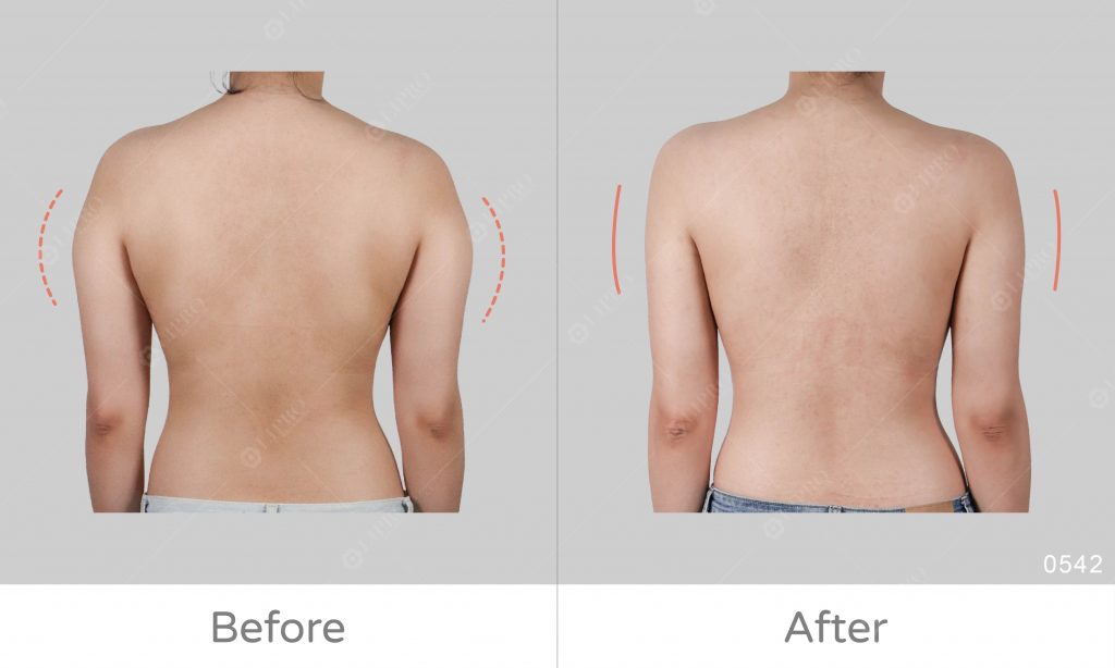手臂與副乳影響後背視覺效果，麗波精緻抽脂一次處理手臂、副乳，減少虎背熊腰的感覺