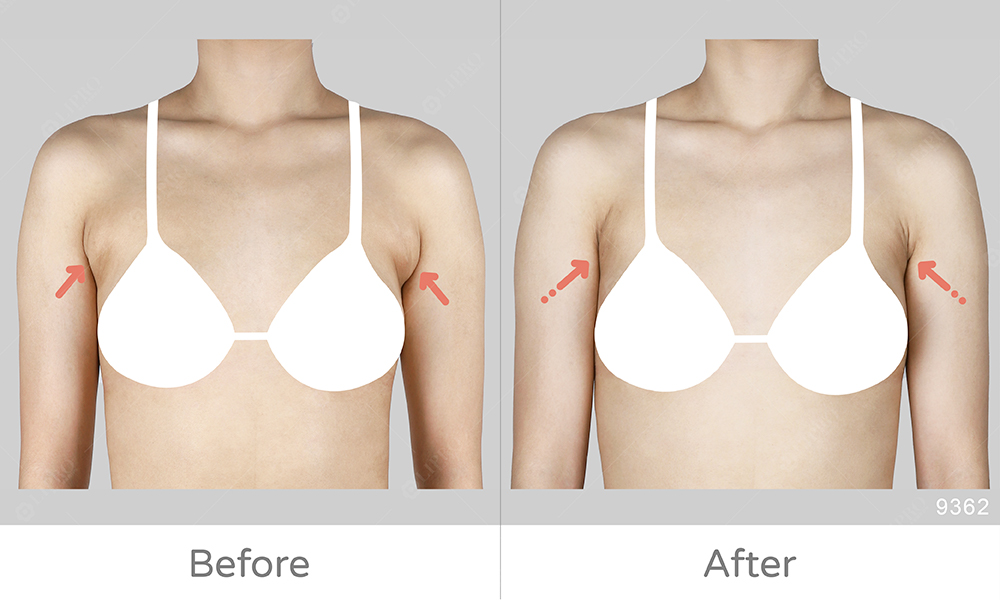 副乳案例類型A:瘦瘦女孩子三角形的副乳，顯微套管抽脂細節處裡