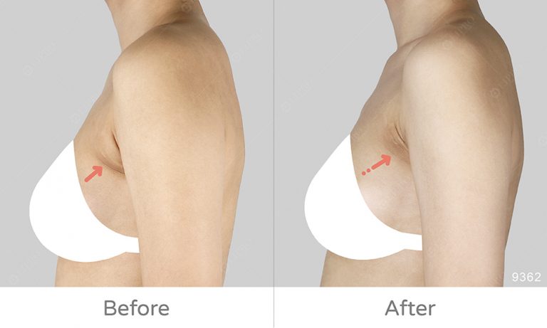 副乳類型A:顯微套管抽脂、腋下副乳細節處理