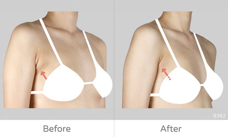 麗波副乳抽脂案例、術前術後成果對比