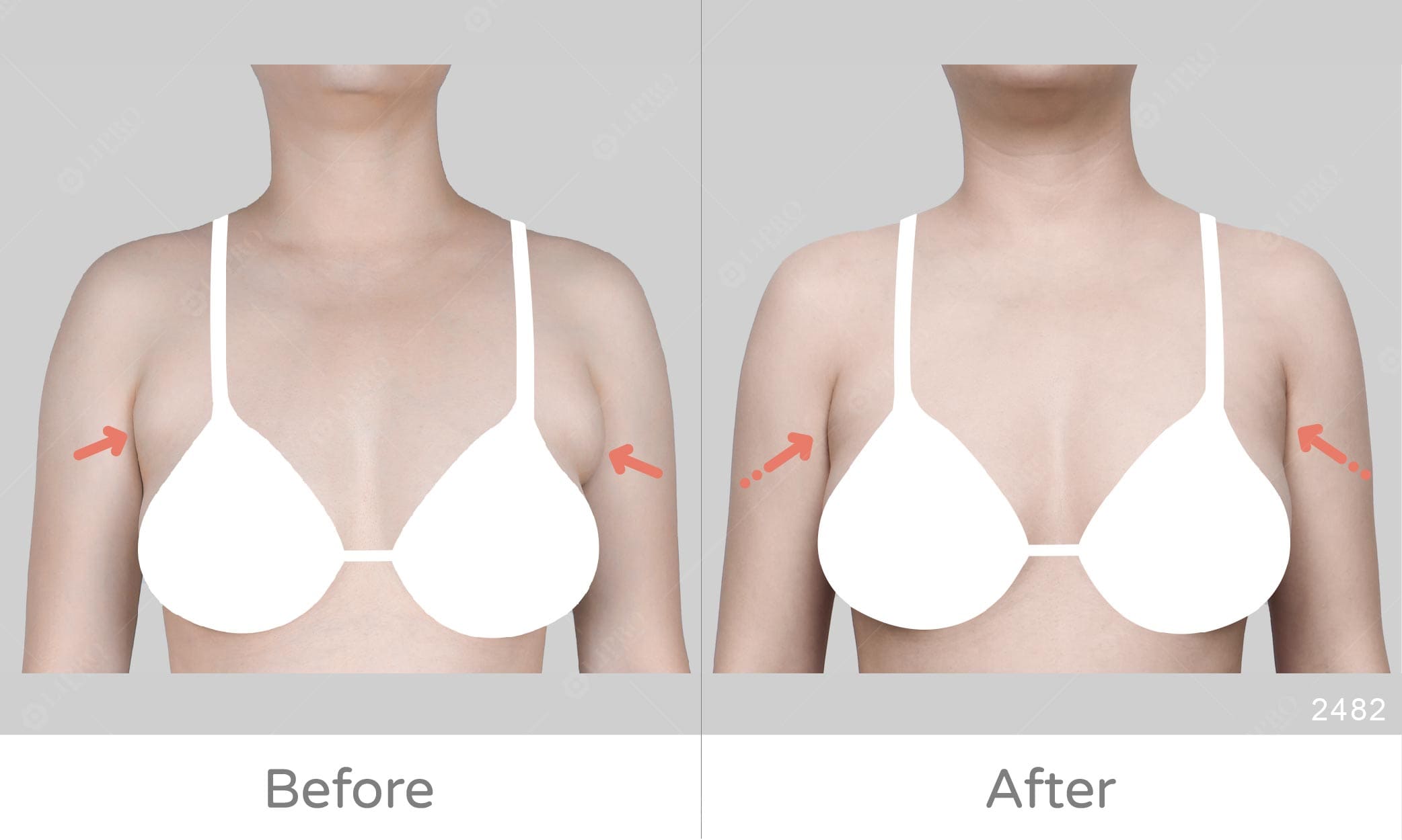 麗波副乳抽脂案例豐富，左右不一致的副乳治療成效佳