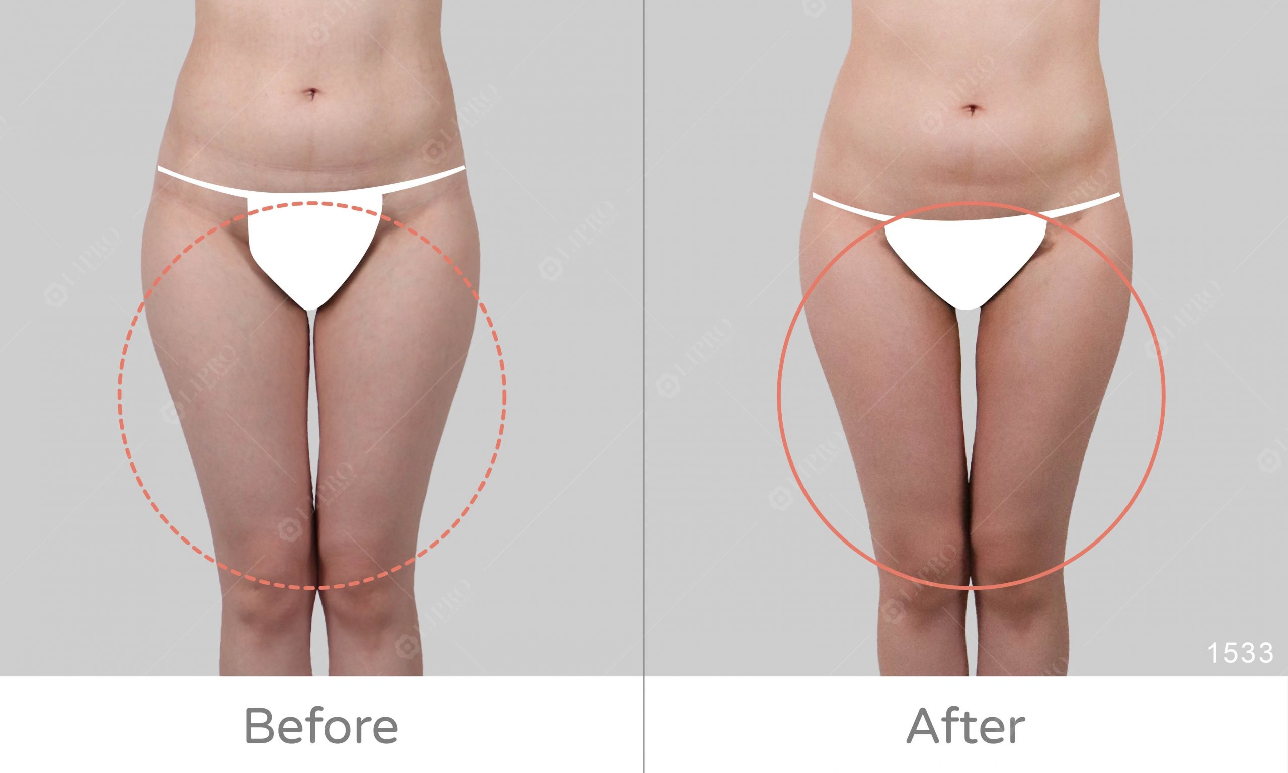 顯微套管抽脂修飾腿內三角，曲線平順、真心推薦