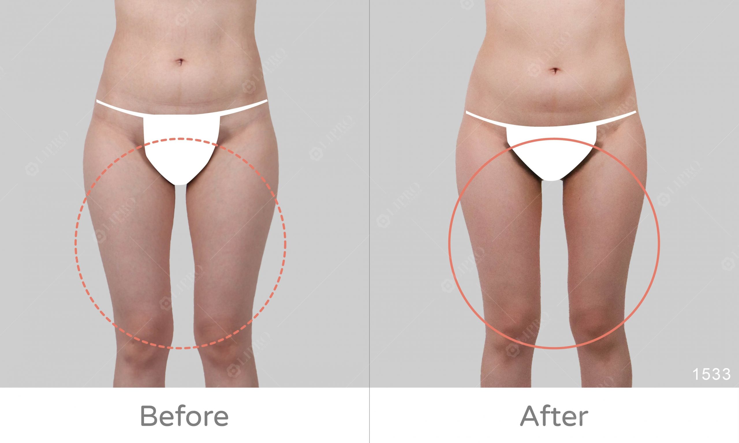 麗波大腿內側抽脂手術傷口極小、恢復快速，網友真心推薦的抽脂診所