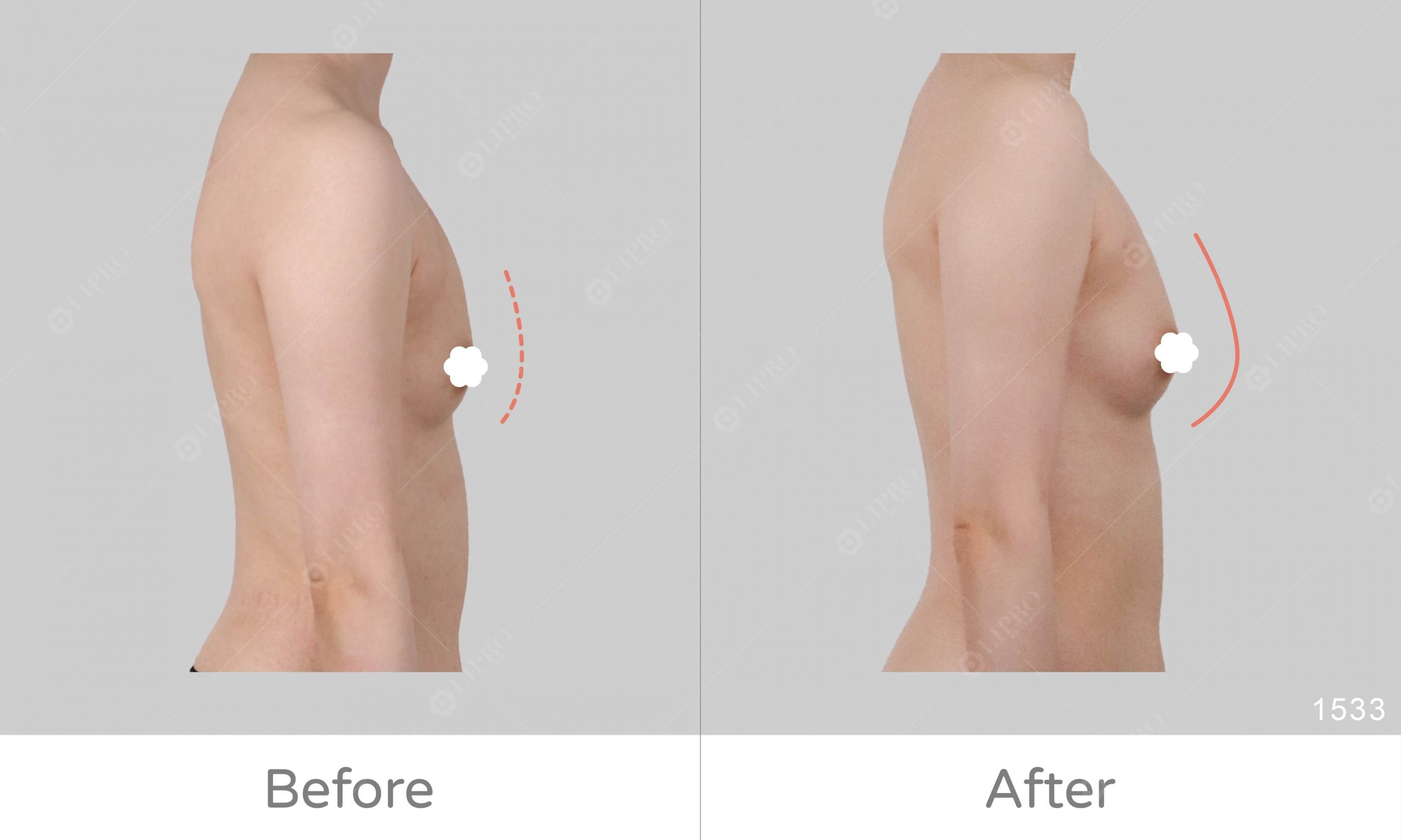 大腿內側抽脂配合自體脂肪補胸，成效明顯看得到