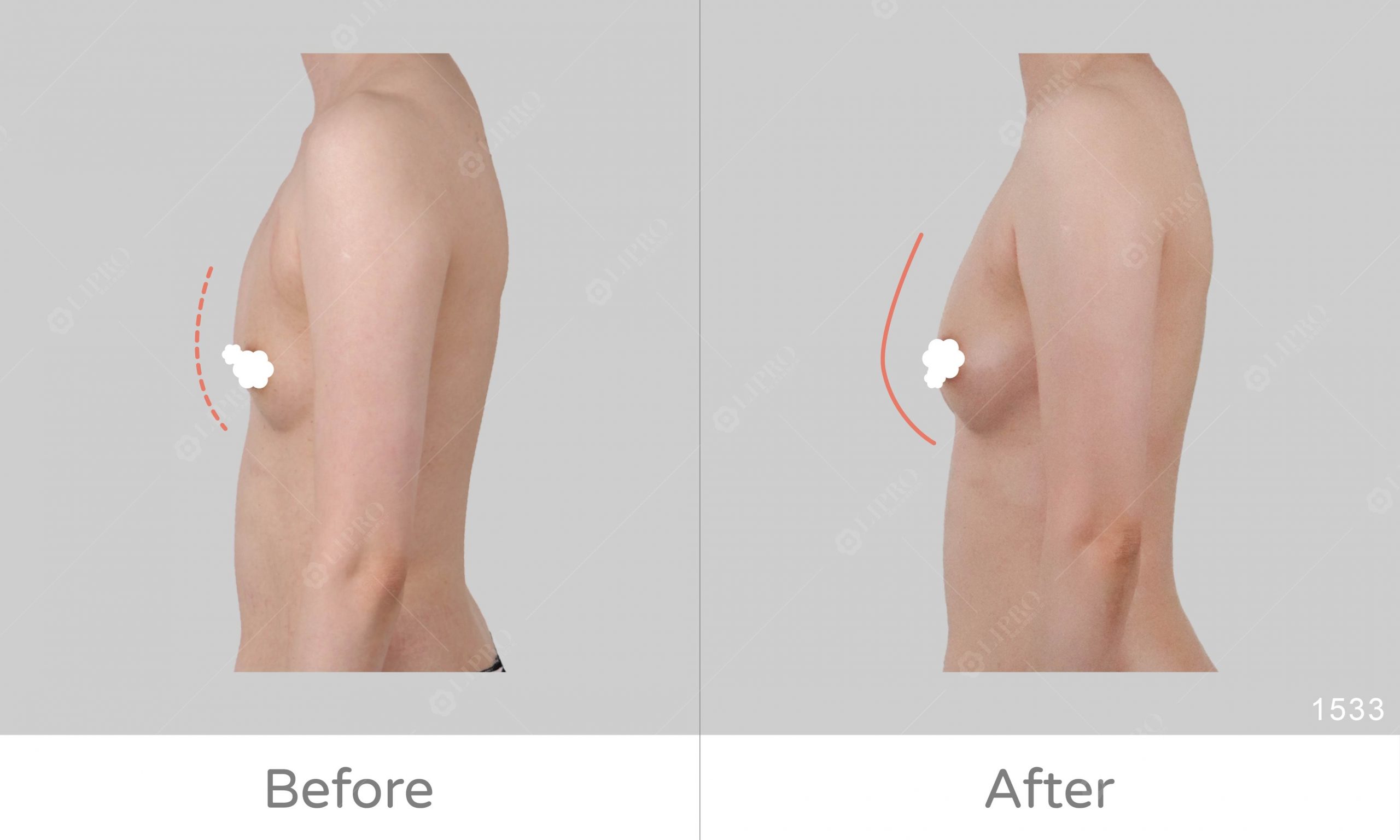 麗波自體脂肪補胸案例分享，術前術後反差明顯，好評推薦