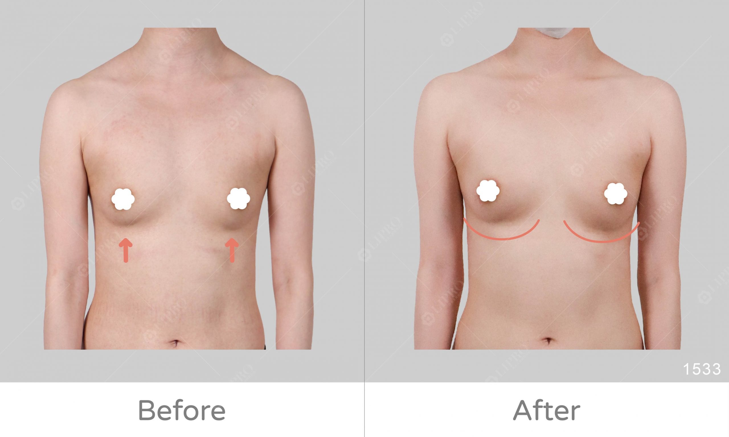 補胸案例對比，術後傷口小、曲線平順，自然美感打滿分