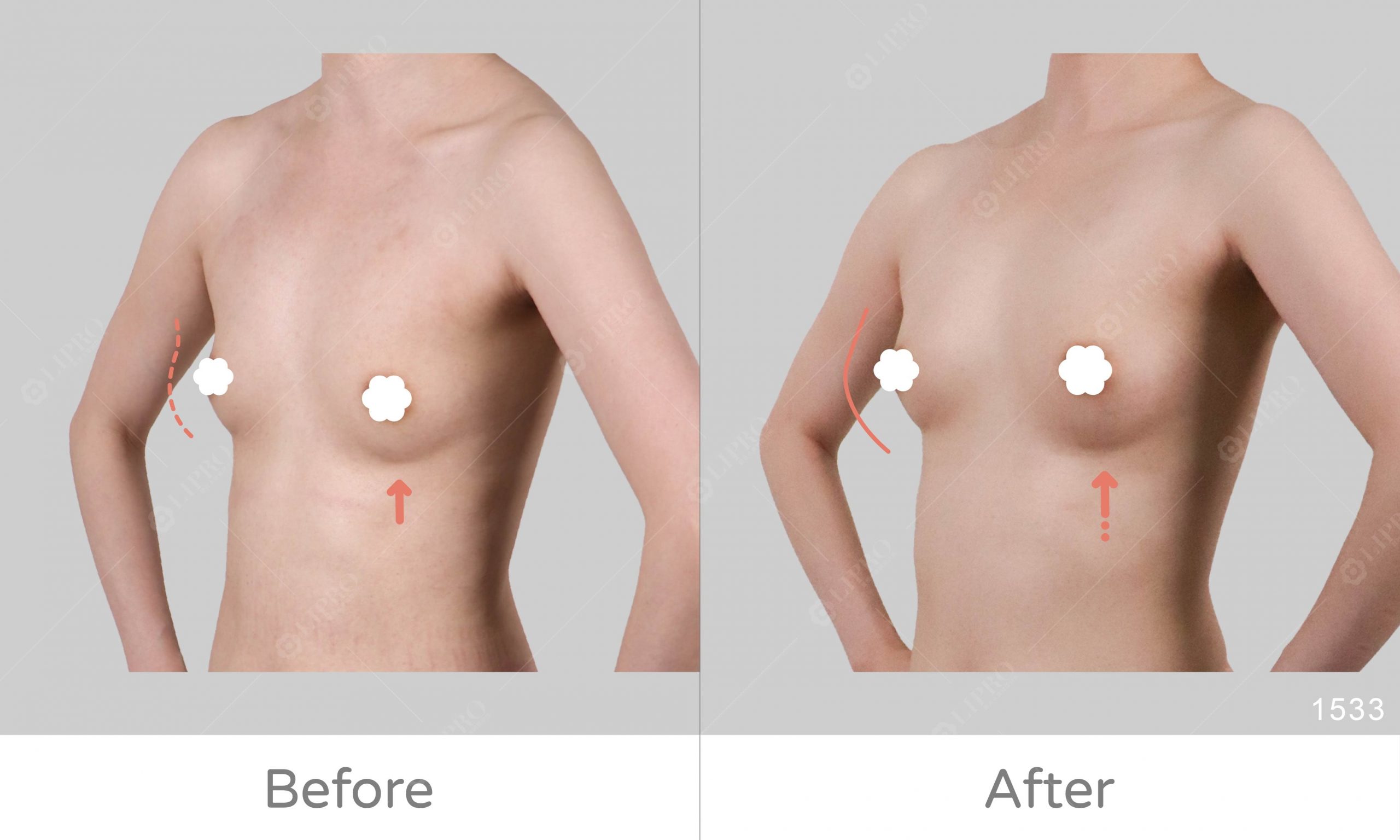 大腿內側抽脂補胸前後對比、顯微套管抽脂技術細膩、曲線自然