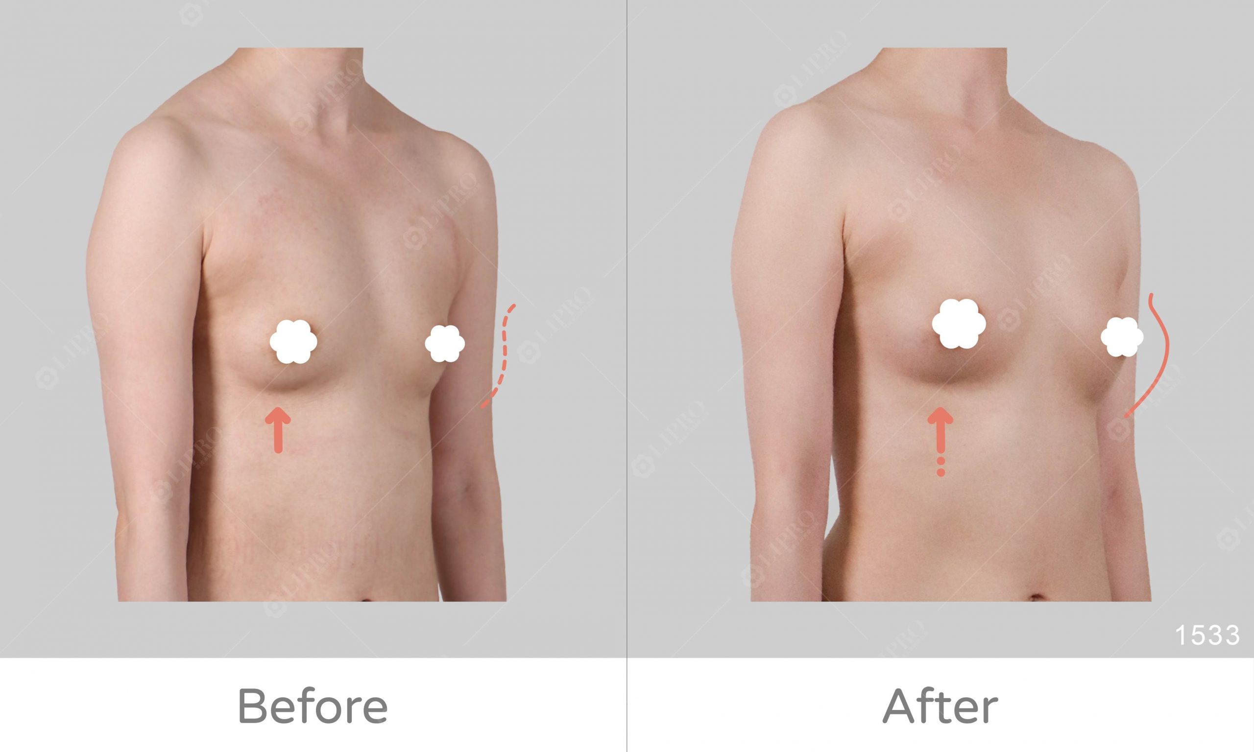 大腿抽脂補胸，自體脂肪移植成效佳，脂肪存活好