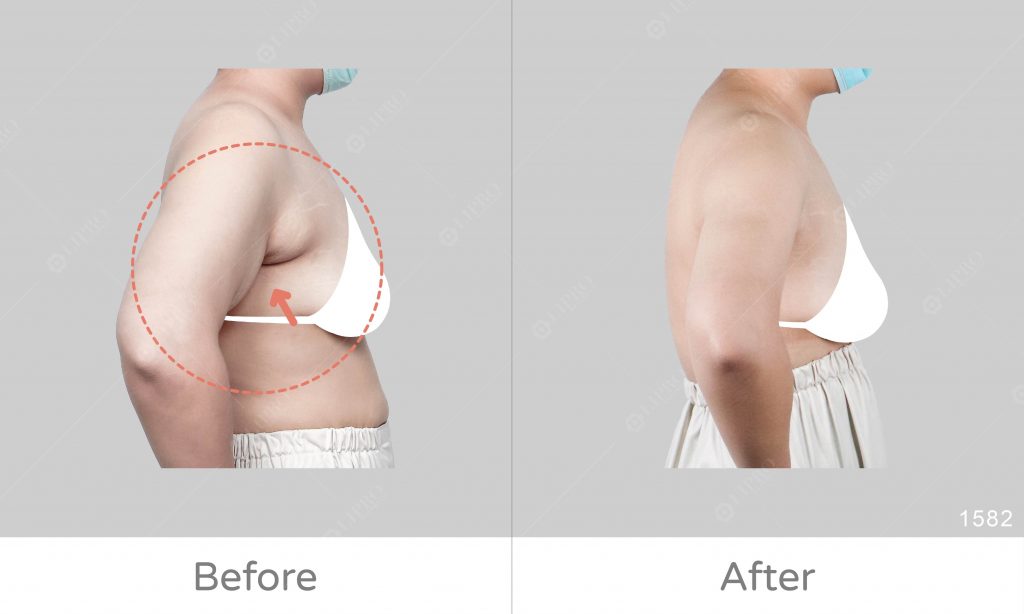 鬆弛副乳案例成果對比，顯微套管抽脂皮膚自然回縮，效果大受好評