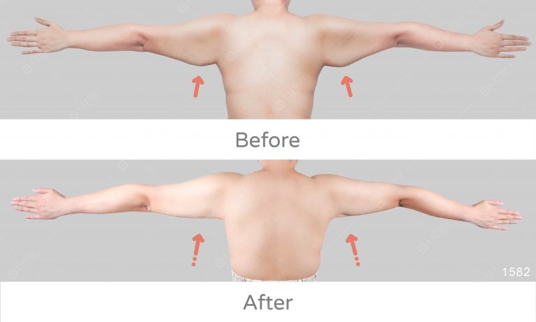 麗波永康鬆弛型副乳案例改變，術後效果見證，不須塑身衣也能緊緻