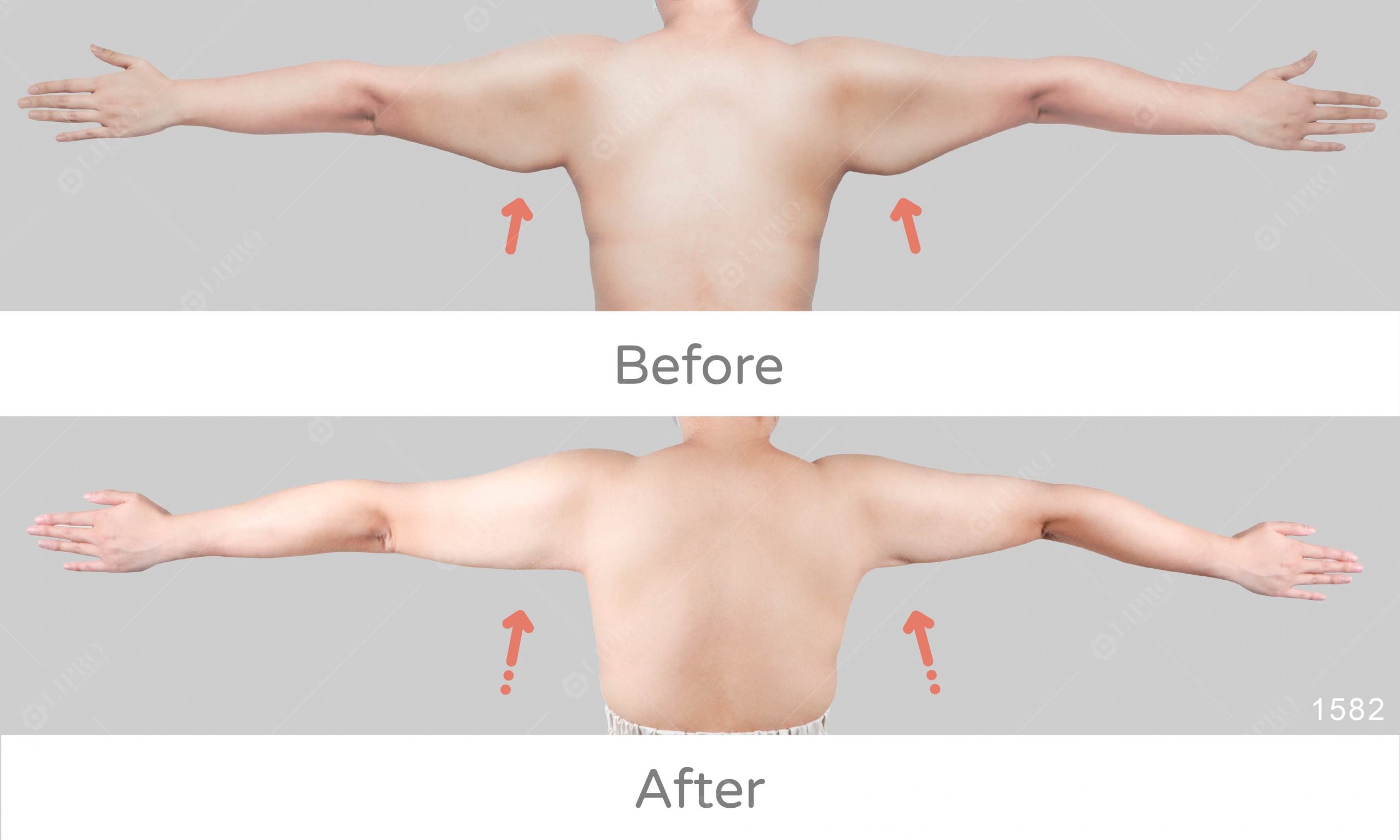 麗波永康鬆弛型副乳案例改變，術後效果見證，不須塑身衣也能緊緻