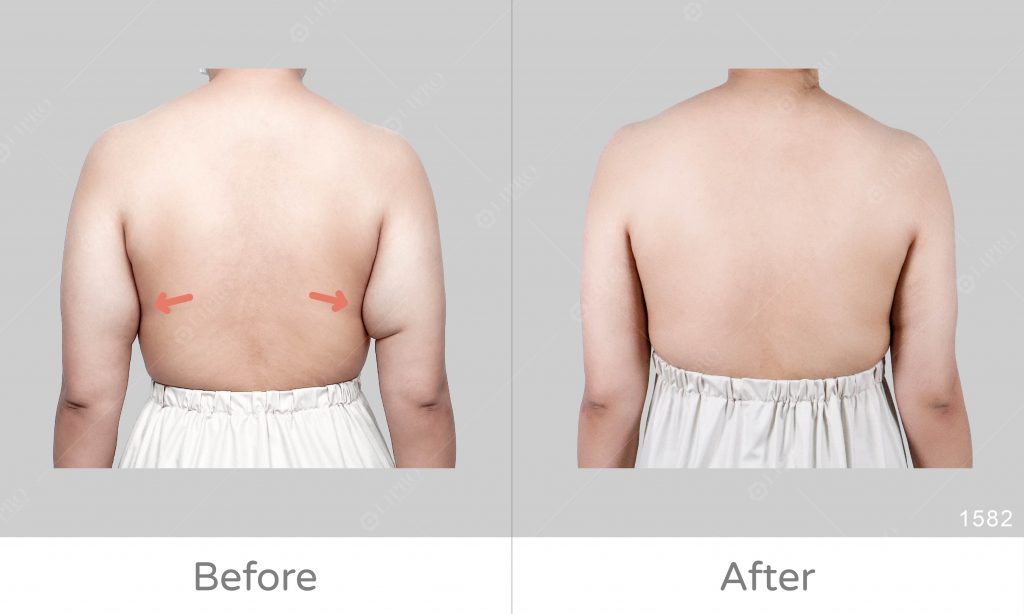 鬆弛手臂和副乳一併處理，麗波顯微套管抽脂精緻調整上半身曲線