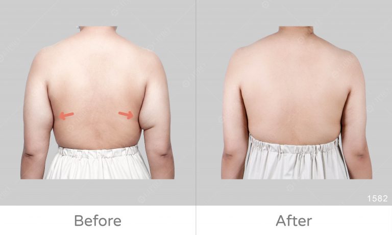 鬆弛手臂和副乳一併處理，麗波顯微套管抽脂精緻調整上半身曲線