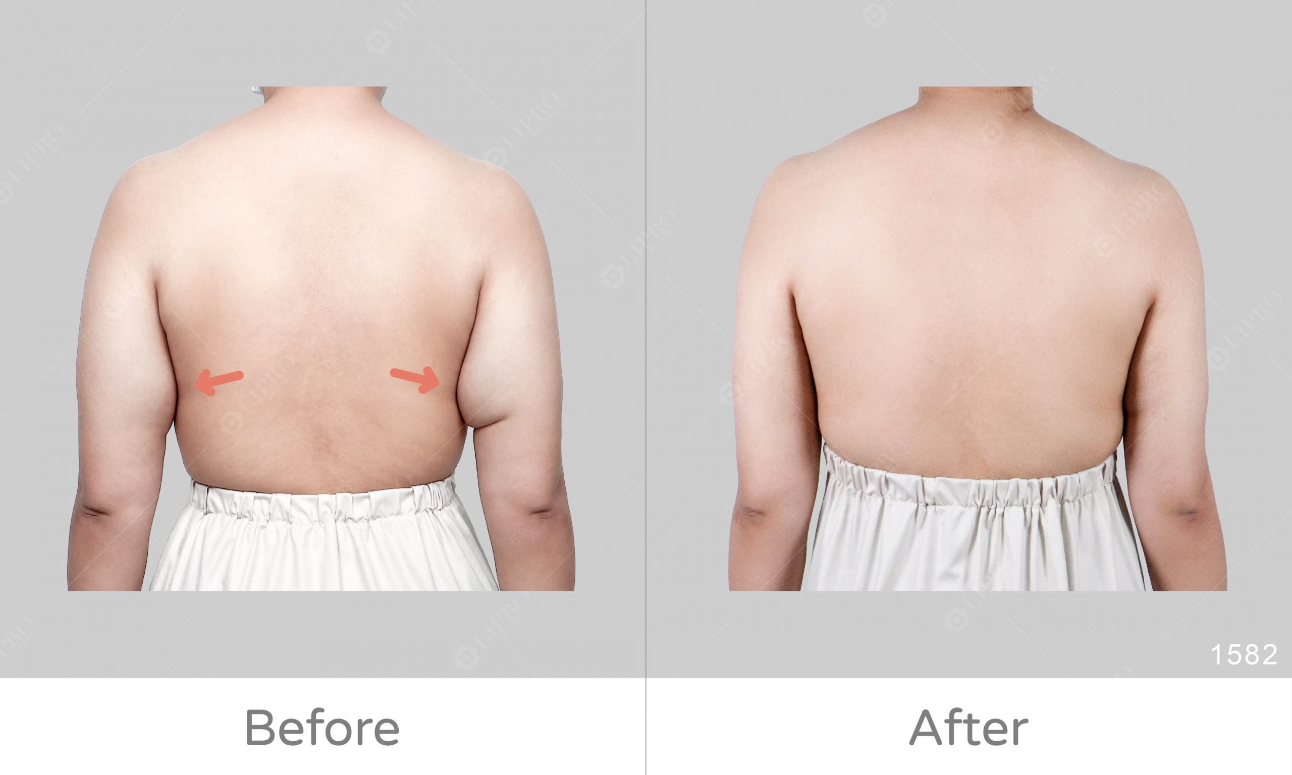 鬆弛手臂和副乳一併處理，麗波顯微套管抽脂精緻調整上半身曲線