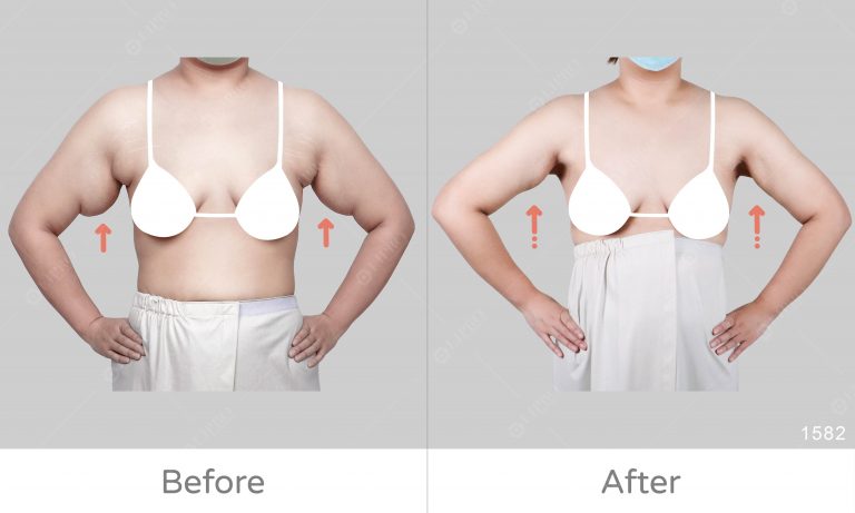 副乳鬆弛案例，顯微套管抽脂術後緊緻成效明顯