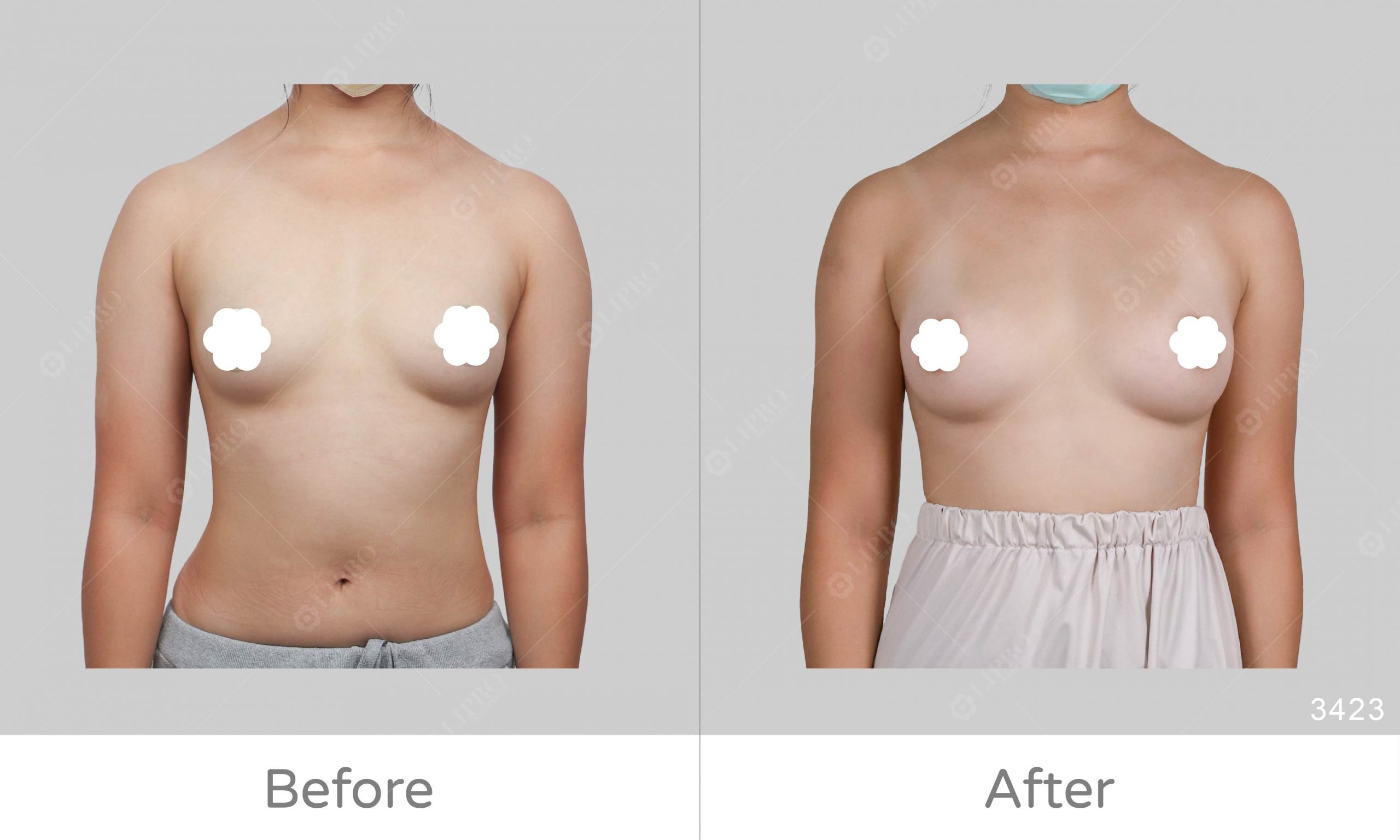 手臂抽脂搭配自體脂肪豐胸，給麗波醫師的細緻指數打滿分