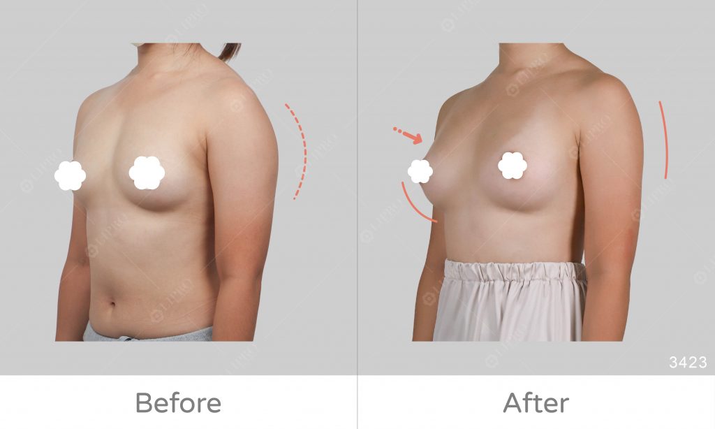 自體脂肪豐胸案例好評回饋，給麗波醫師的細緻打滿分