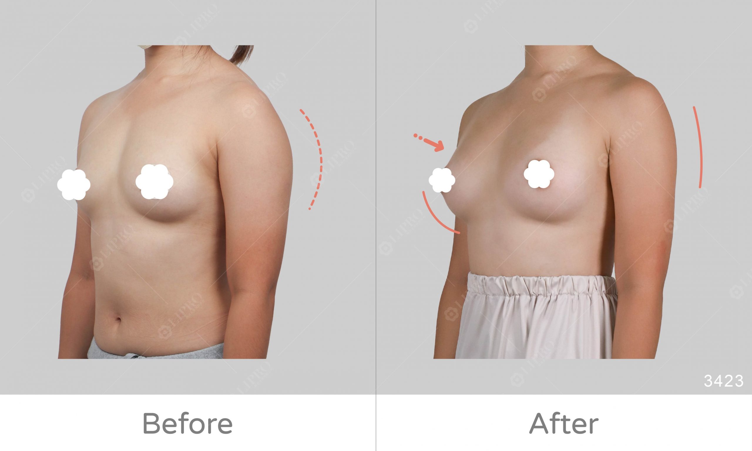 自體脂肪豐胸案例好評回饋，給麗波醫師的細緻打滿分