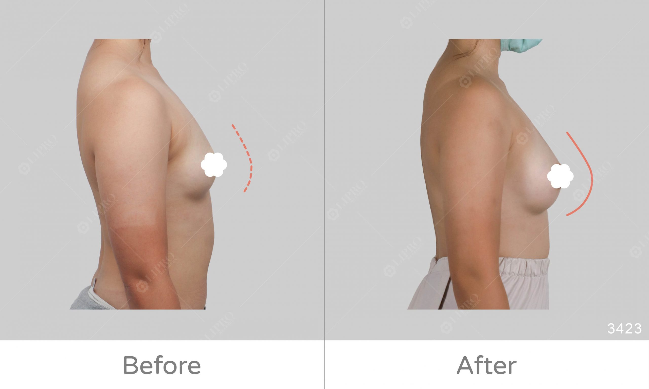 豐胸前後比對示意圖，麗波自體脂肪移植豐胸案例成效明顯