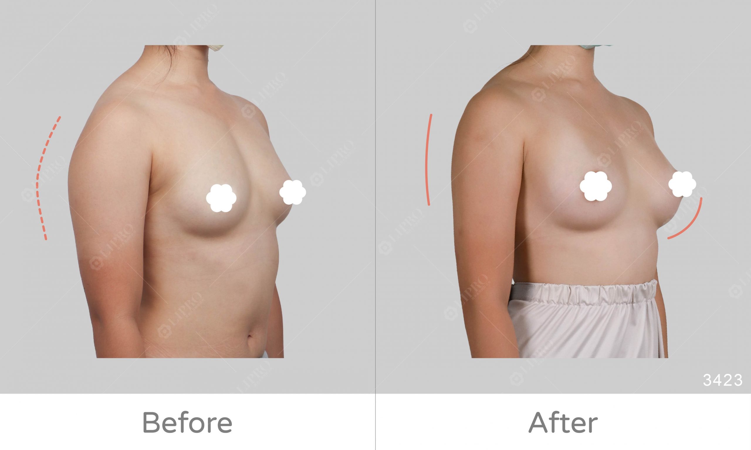 自體脂肪移植豐胸案例術前術後效果顯著，麗波好評案例回饋