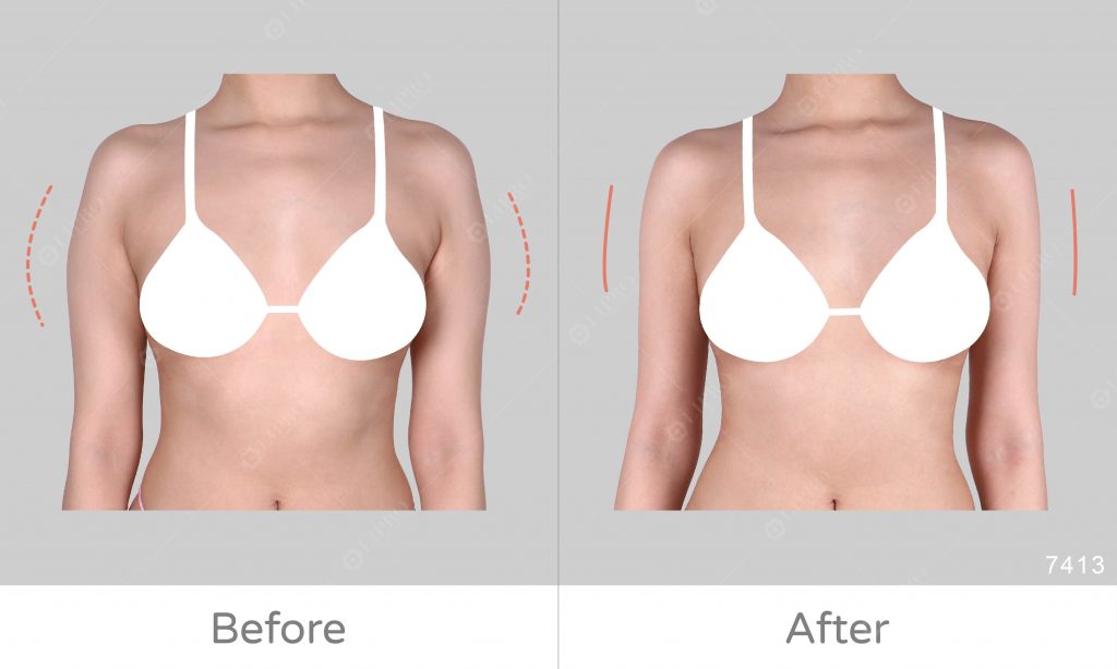 顯微套管手臂抽脂，調整曲線細節，手臂抽脂案例成果