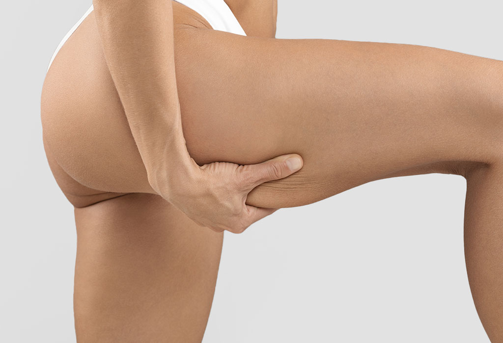 大腿抽脂適合對象:胖過再瘦，皮膚鬆弛，顯微套管抽脂擅長處理鬆弛的皮膚，再上電漿做組織的緊緻化，能夠有良好的效果。