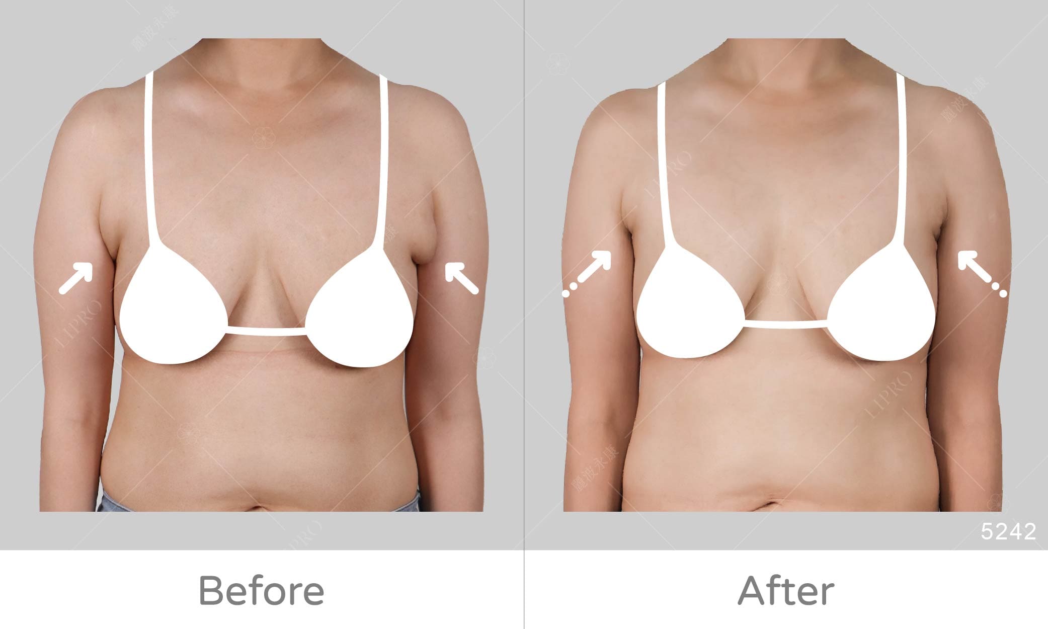 有副乳問題如何解決?顯微套管副乳抽脂優勢多，可清醒手術更安心