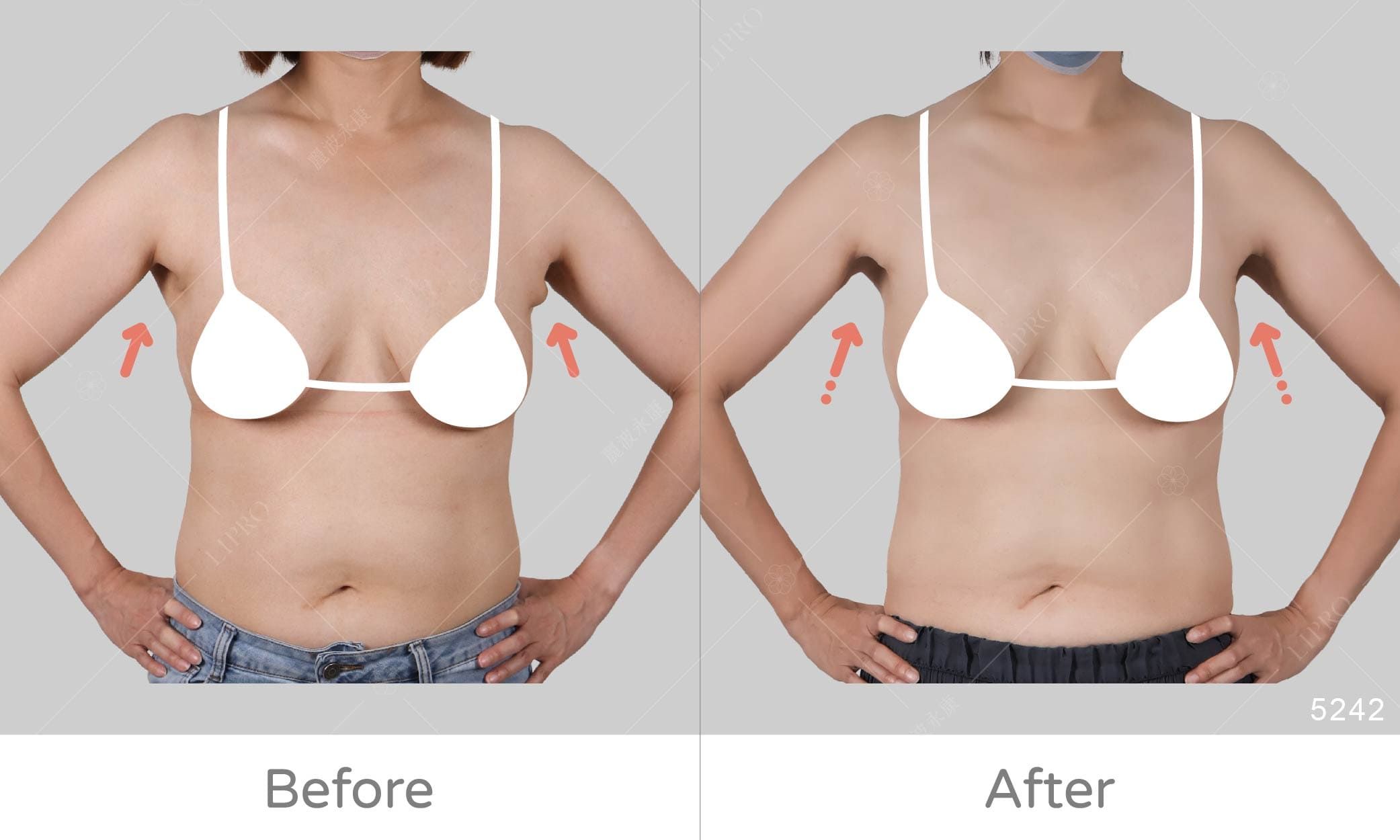 副乳案例_副乳困擾一天解決，顯微套管抽脂手術移除副乳，術後恢復快速