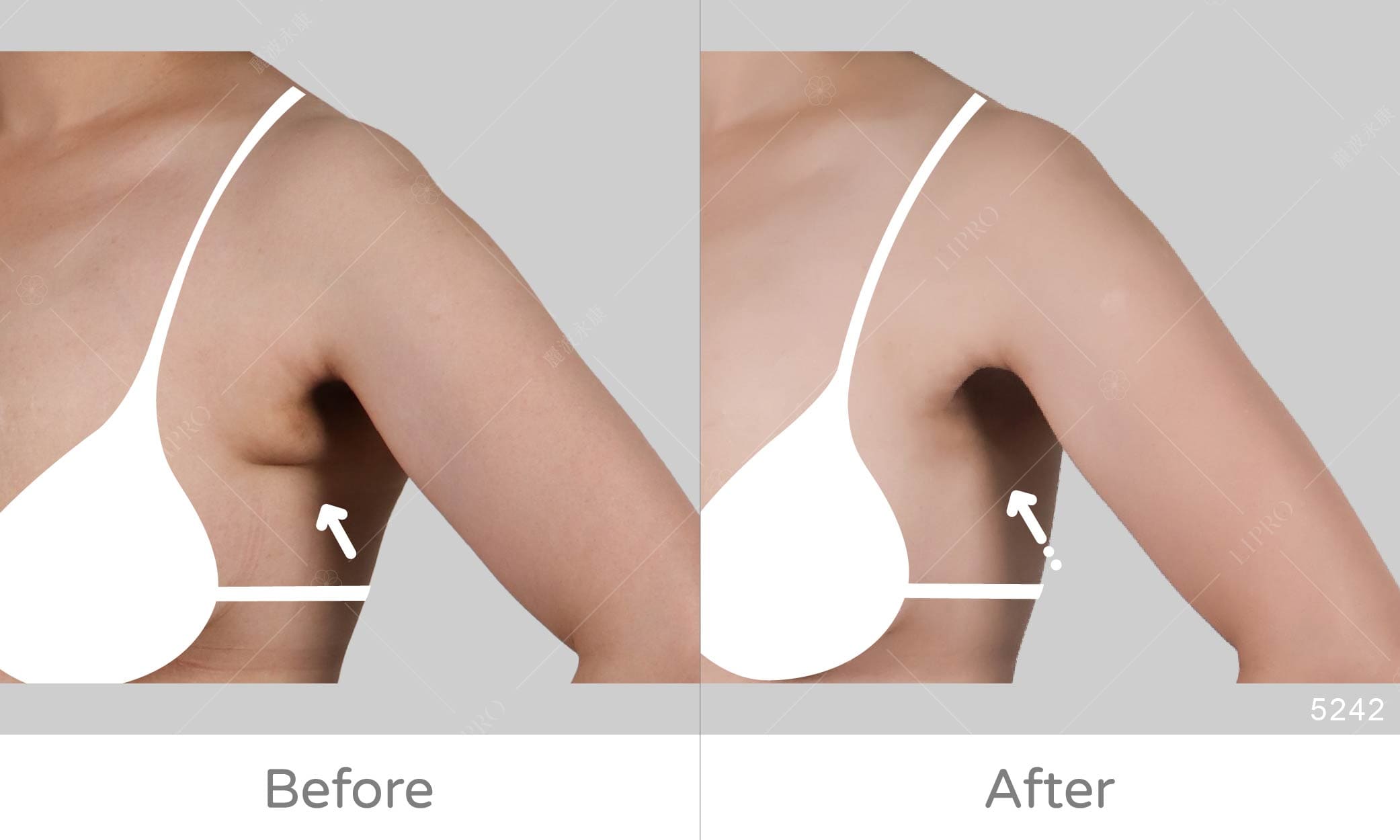 副乳抽脂，腋下副乳精緻處理，麗波副乳抽脂手術推薦