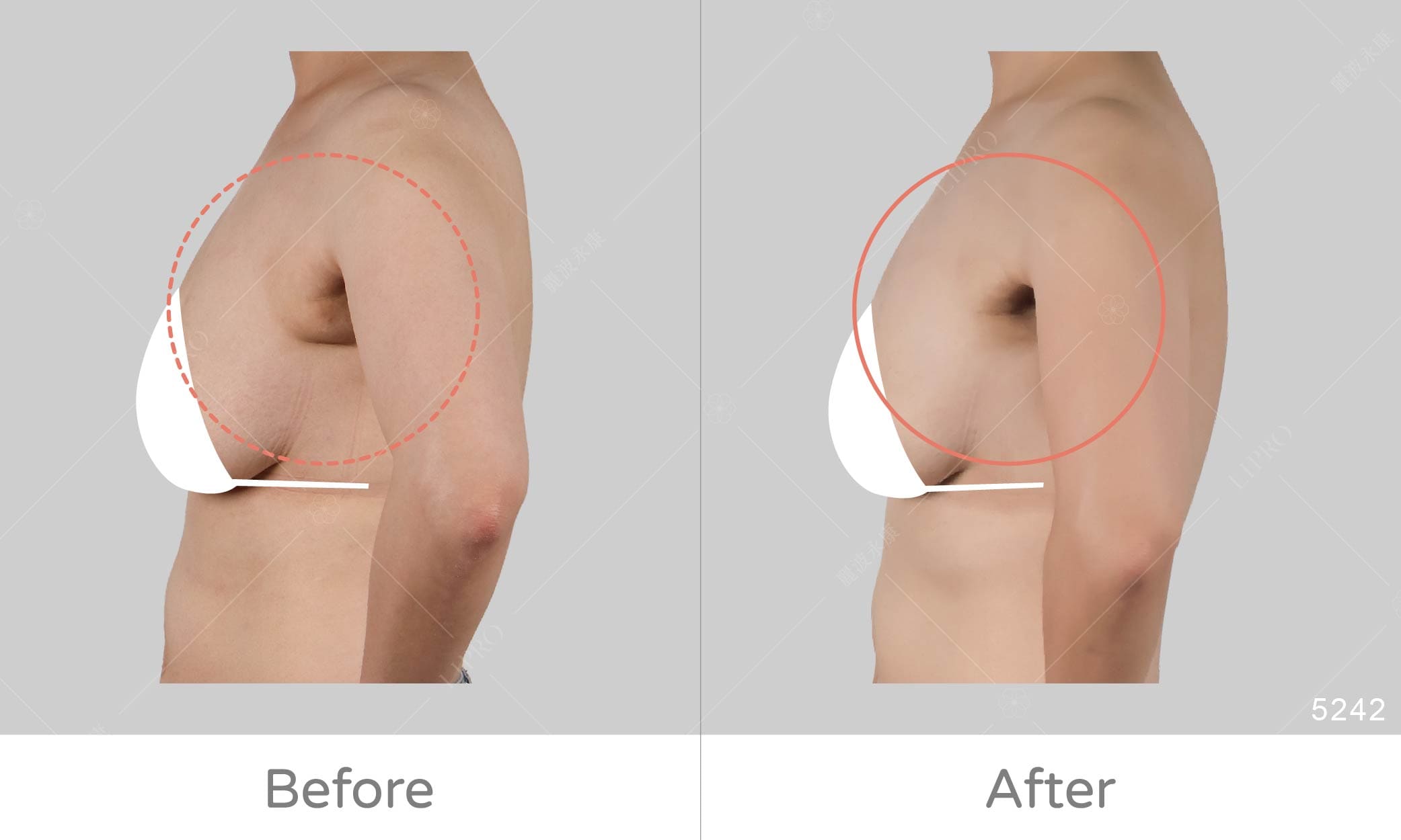 顯微套管抽脂術帶你擺脫副乳困擾，術後不需塑身衣，恢復快速不留疤