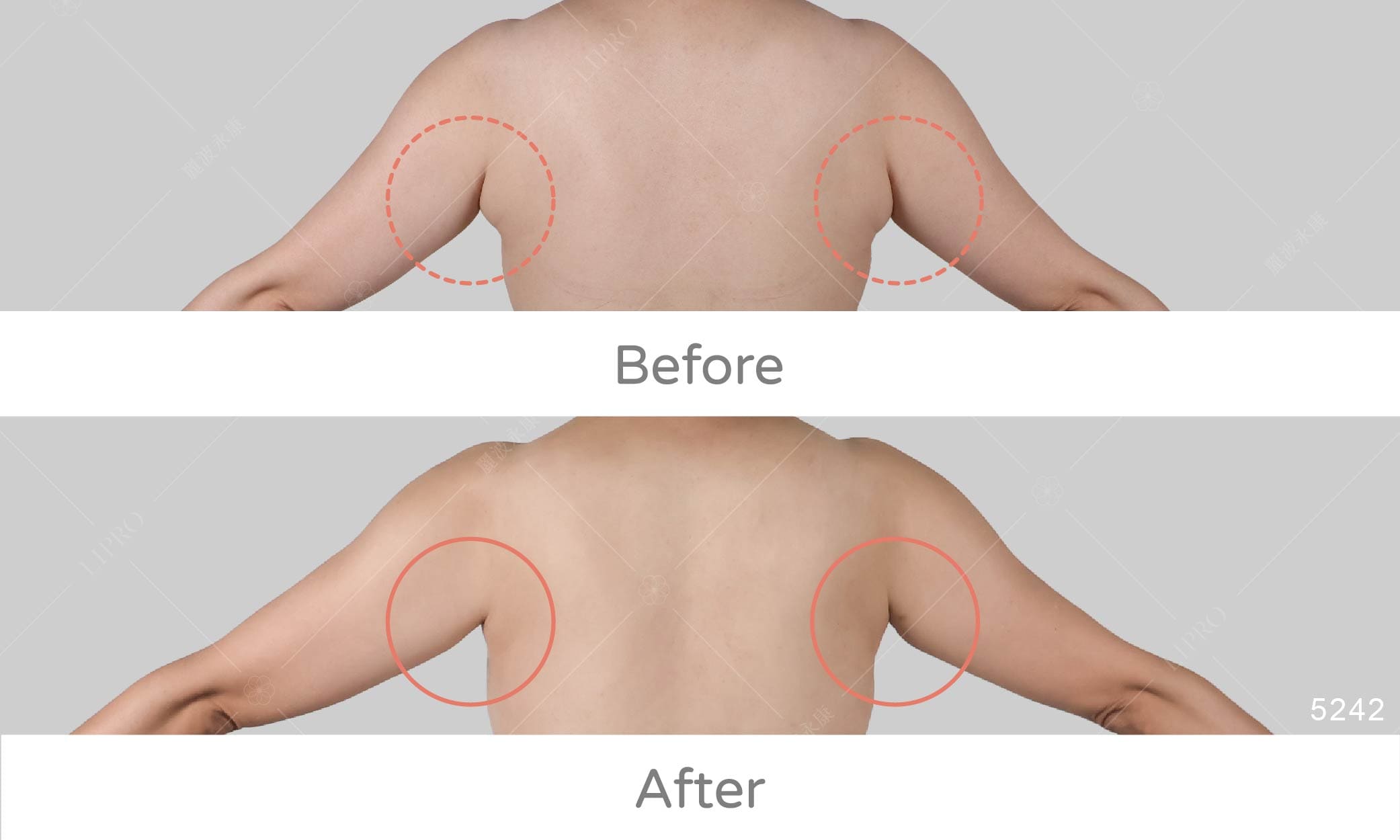 副乳消除案例見證，麗波專擅顯微套管抽脂術、不須切皮也能有效移除乳腺