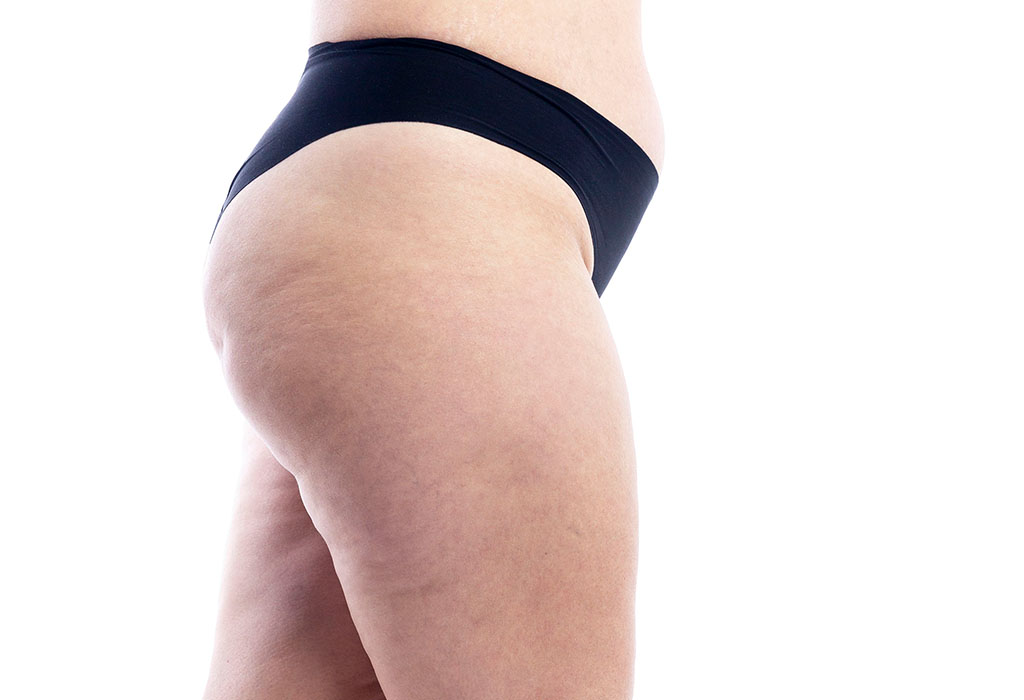 大腿抽脂適合對象:凹凸不平修復者，凹凸不平示意4麗波永康注重動靜態曲線的平順，在凹凸不平修復方面有豐富經驗。