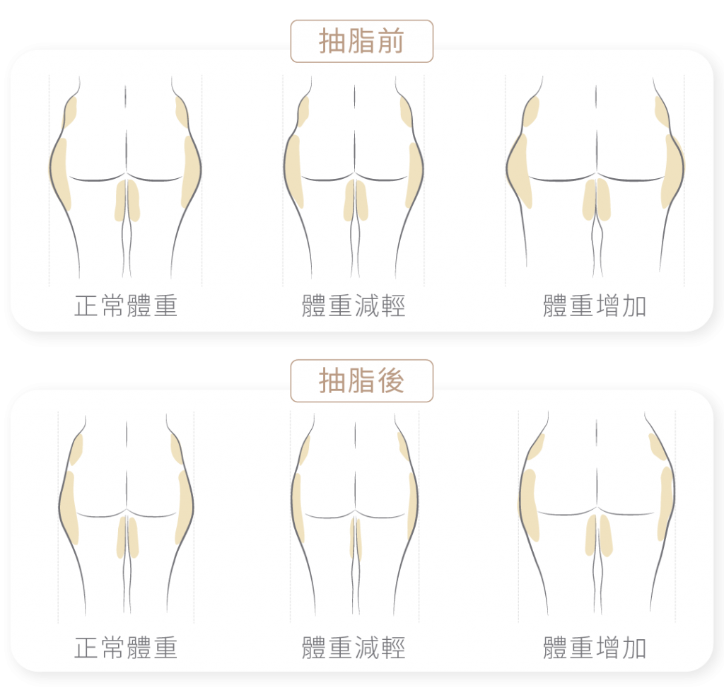 FQA抽脂在於曲線的改變，只要體重不要急速增加，基本上復胖的機率很小。