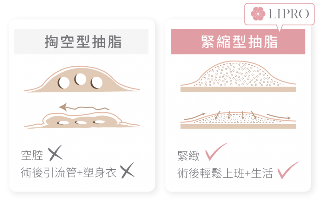 FQA麗波永康國際診所使用的顯微套管抽脂技術對組織傷害極小，因此不需要穿塑身衣