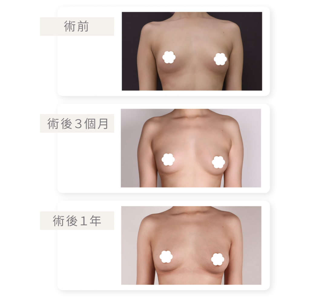 脂肪存活好，移植效果便能長久，若乳房有產後萎縮的情況，搭配顯微套管自體脂肪豐胸也能有不錯的效果。